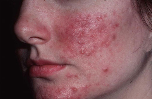 Rosacea
