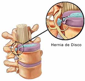 Hernia de disco