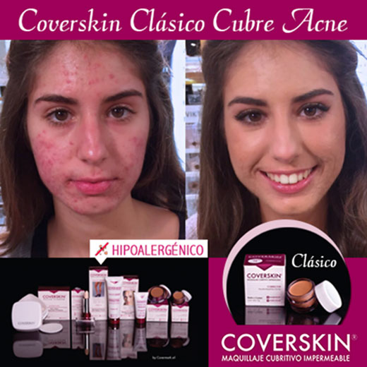 Coverskin Acne