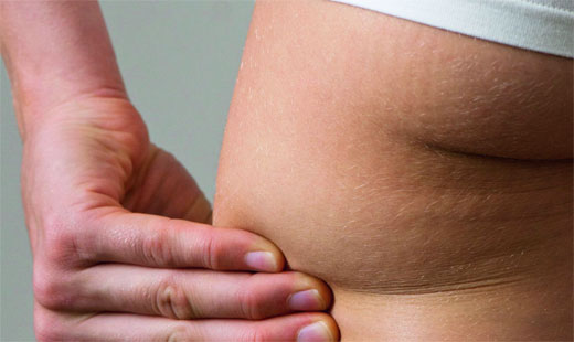 CELULITIS