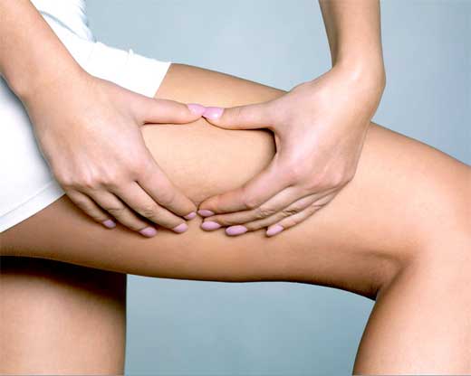 CELULITIS