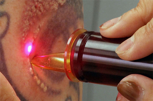 TATUAJES LASER