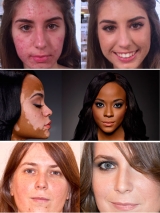 Maquillajes cubritivos para acn, roscea y vitiligo